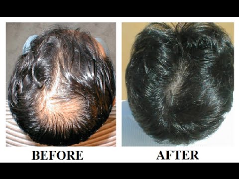 how to regrow hair in lost areas